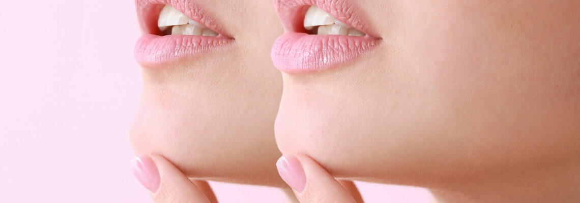 Vaccino e Filler, ci sono controindicazioni?