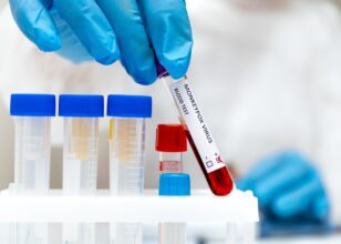 Vaiolo delle scimmie: la nuova emergenza sanitaria