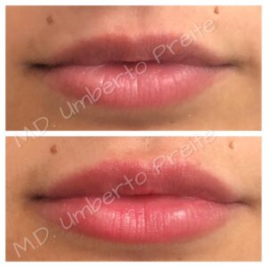Filler Labbra | Dott. Umberto Preite