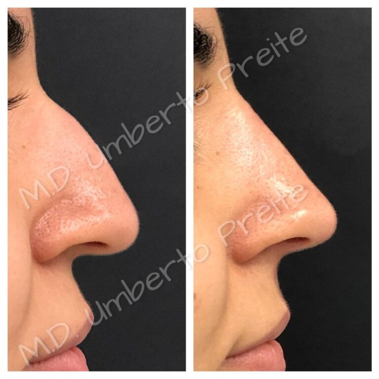 Filler Naso 2/2 | Dott. Umberto Preite