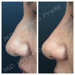 Filler Naso 1/2 | Dott. Umberto Preite